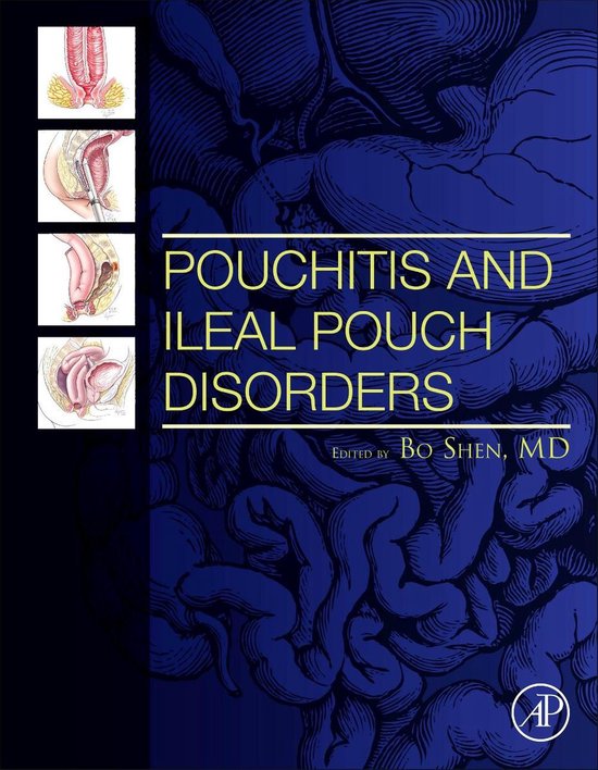 9780128094020 Pouchitis and Ileal Pouch Disorders